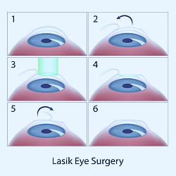 What are the Differences Between PRK and LASIK? | Queens NY